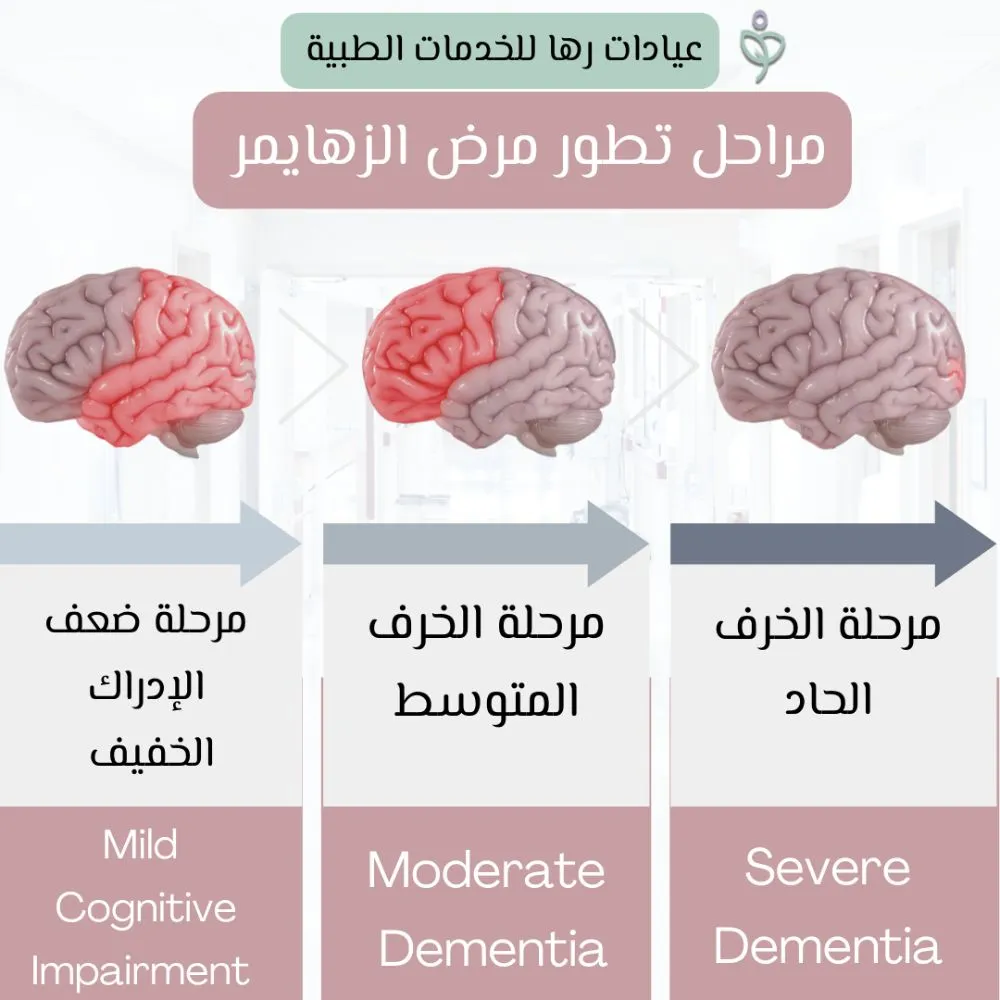 مراحل تطور الزهايمر عند المسنين